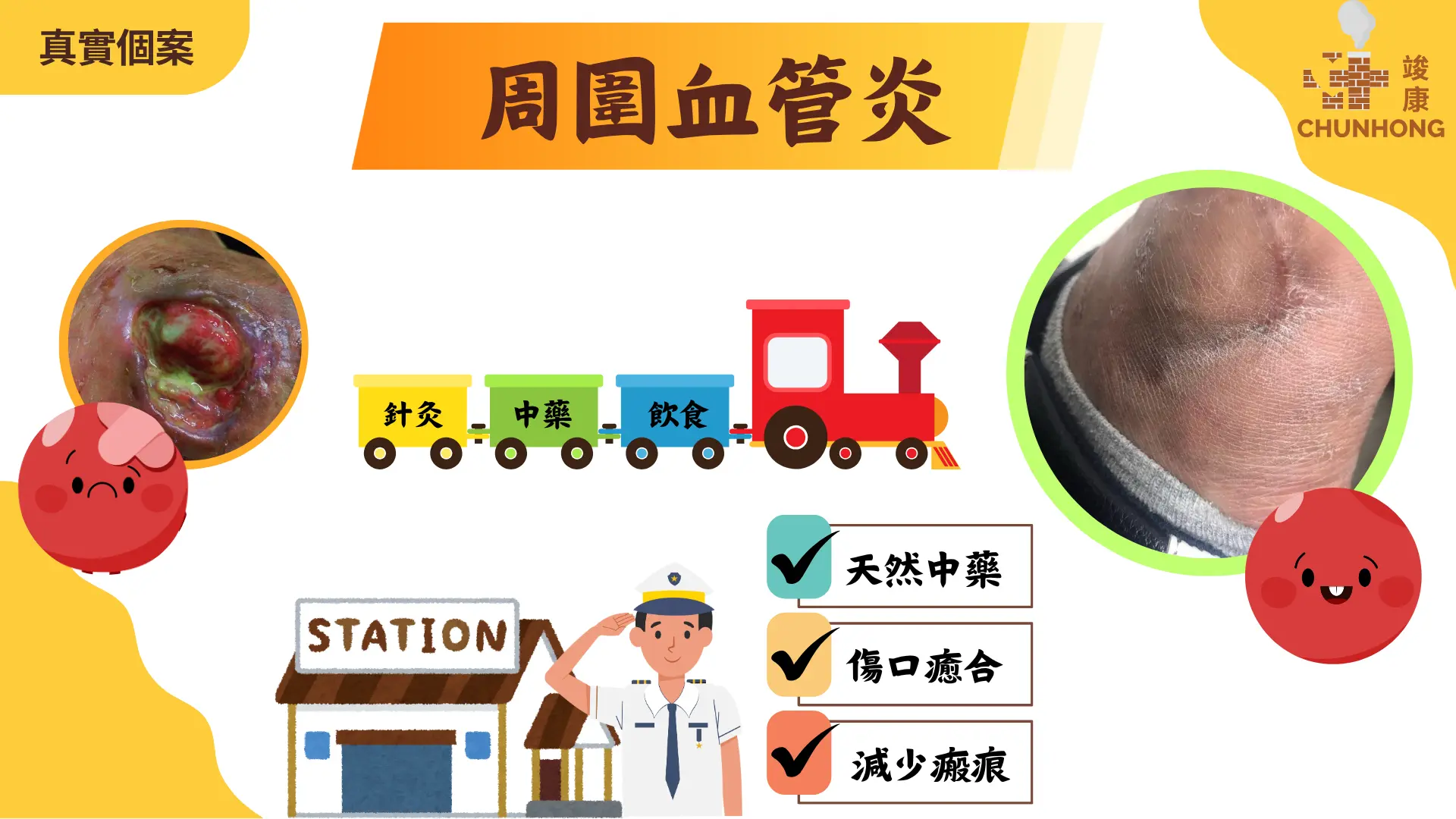 周圍血管炎poster (簡報)