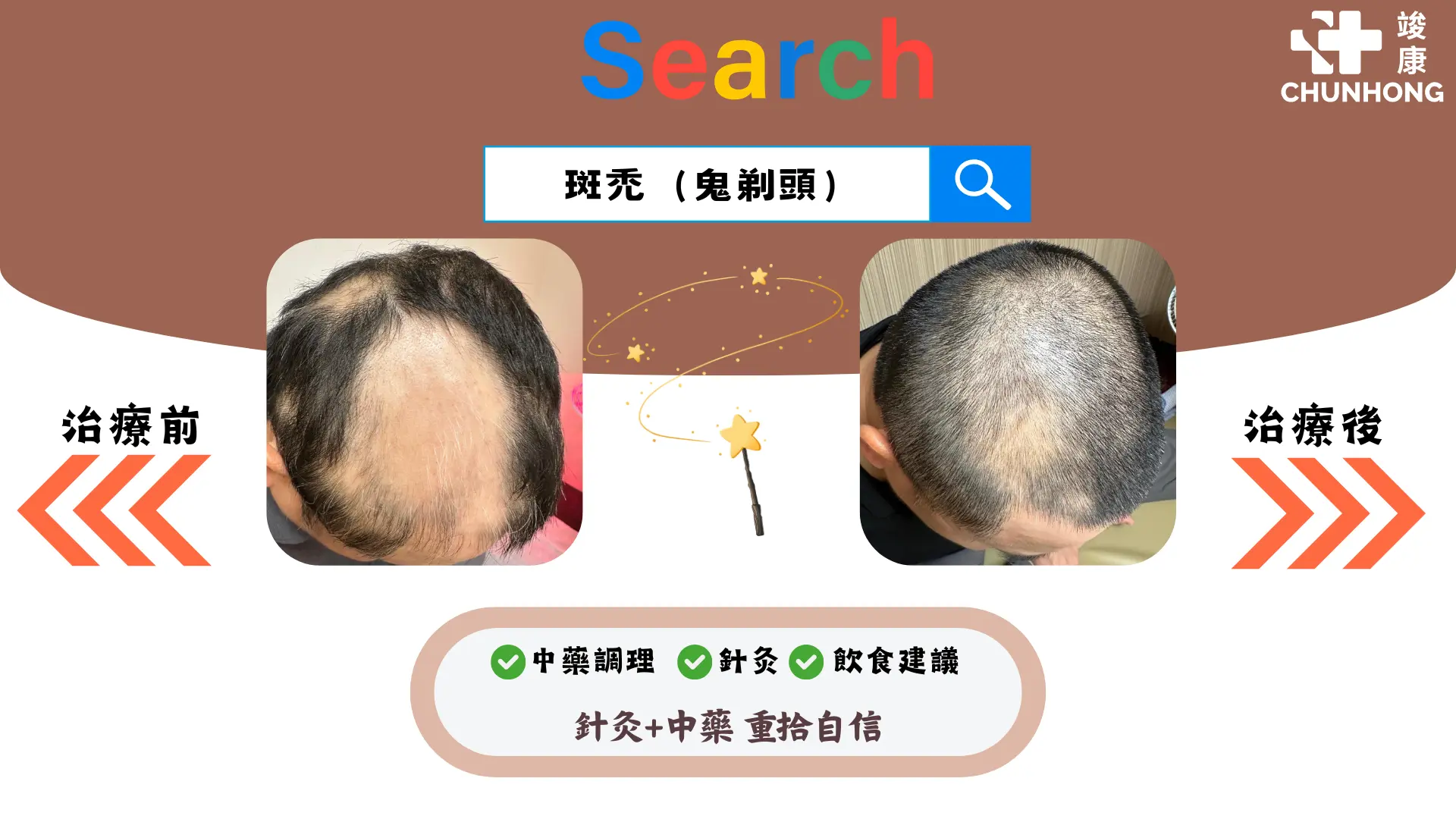 斑禿poster (簡報)
